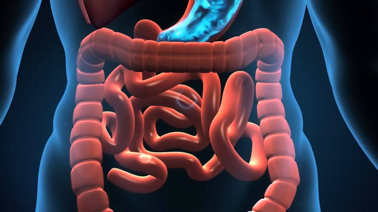 Diverticulitis acute