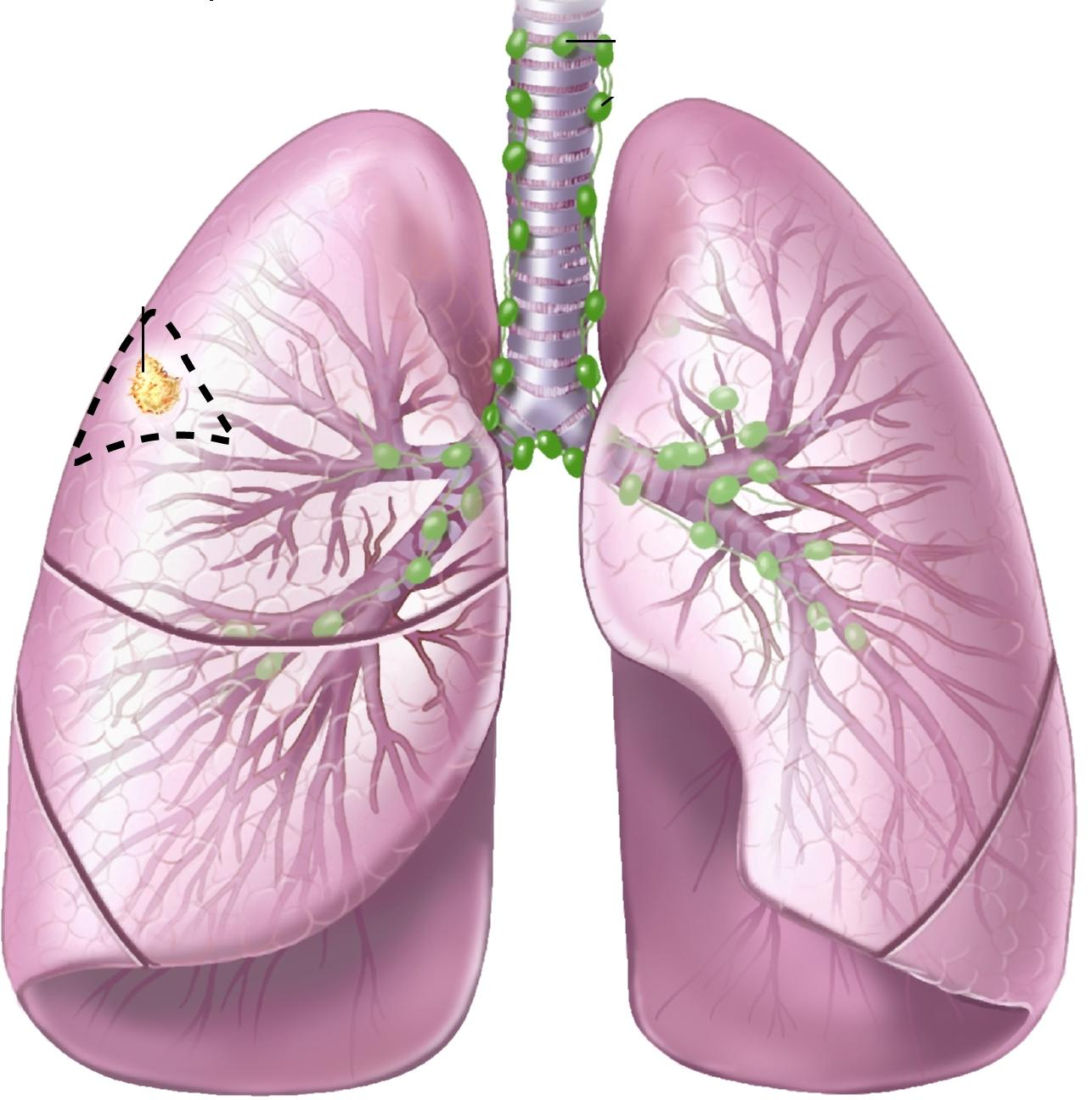 Emphysema