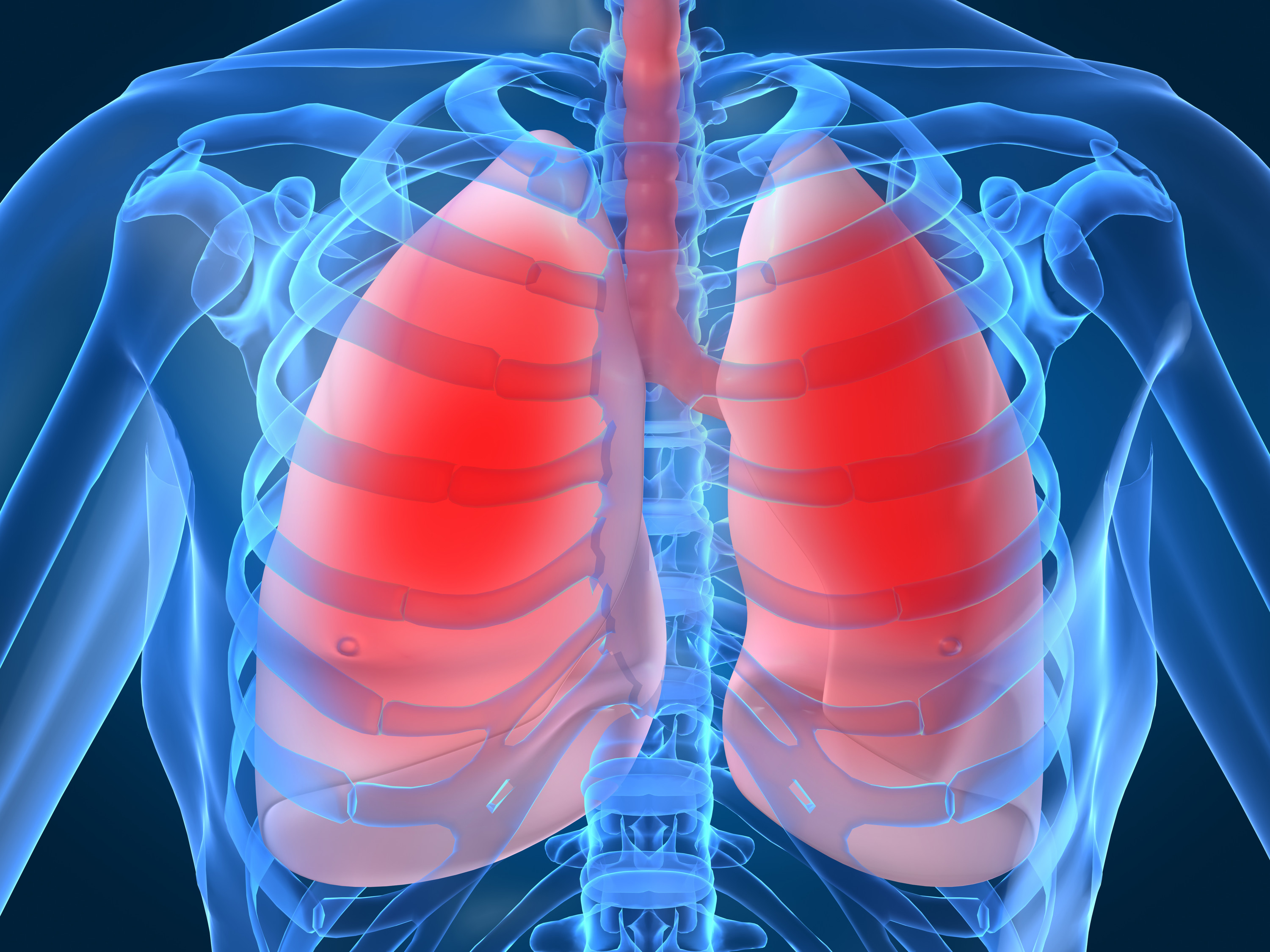 Chest pain (Intercostal neuralgia)