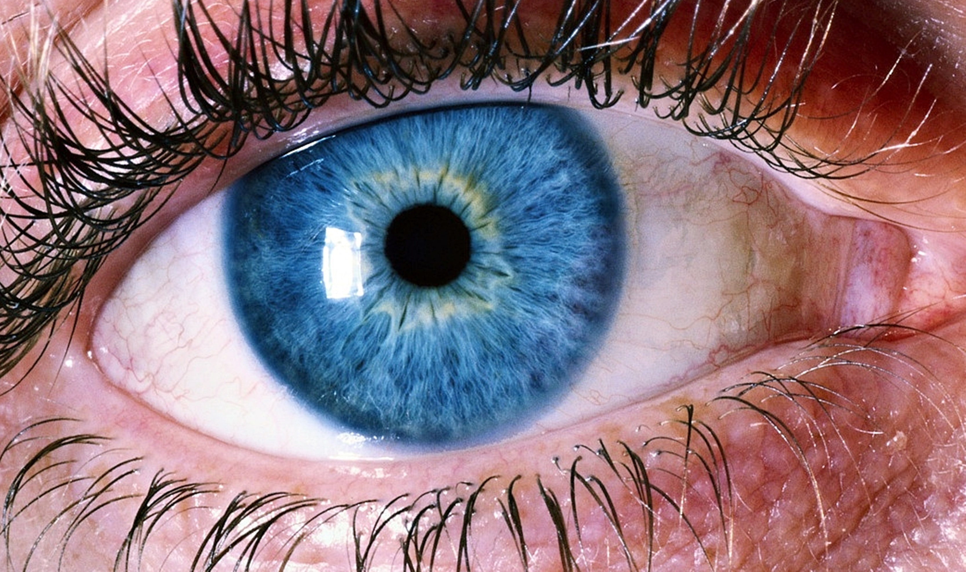 Cataract