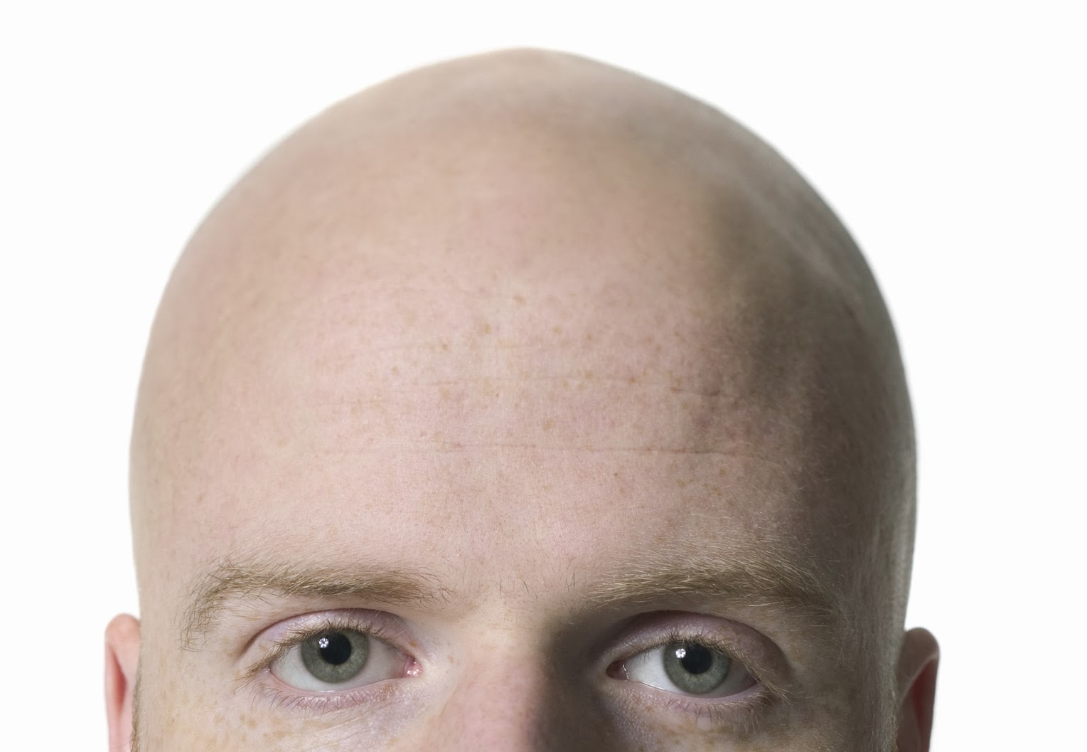 Alopecia (Baldness)