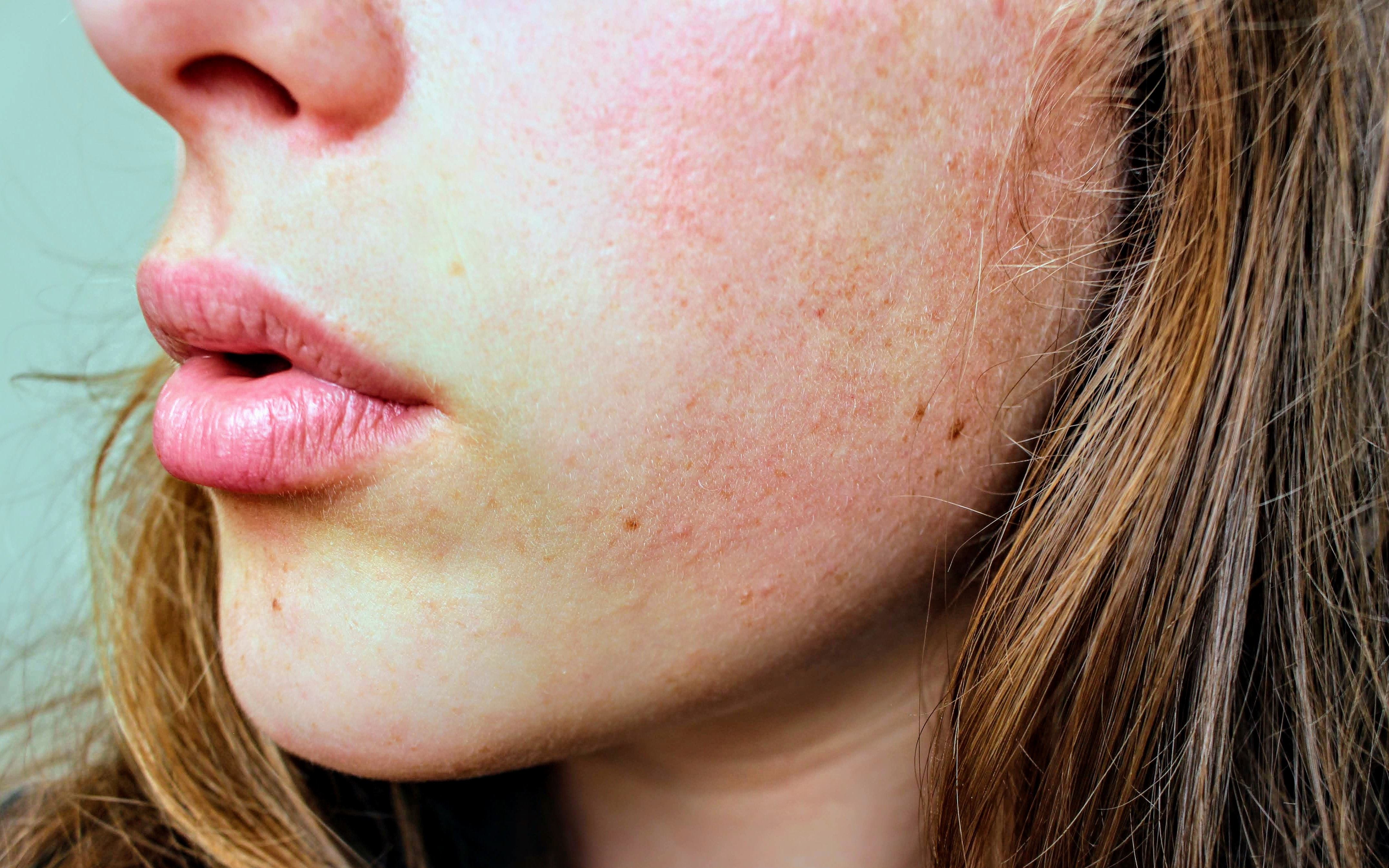 Skin Rashes (Urticaria)