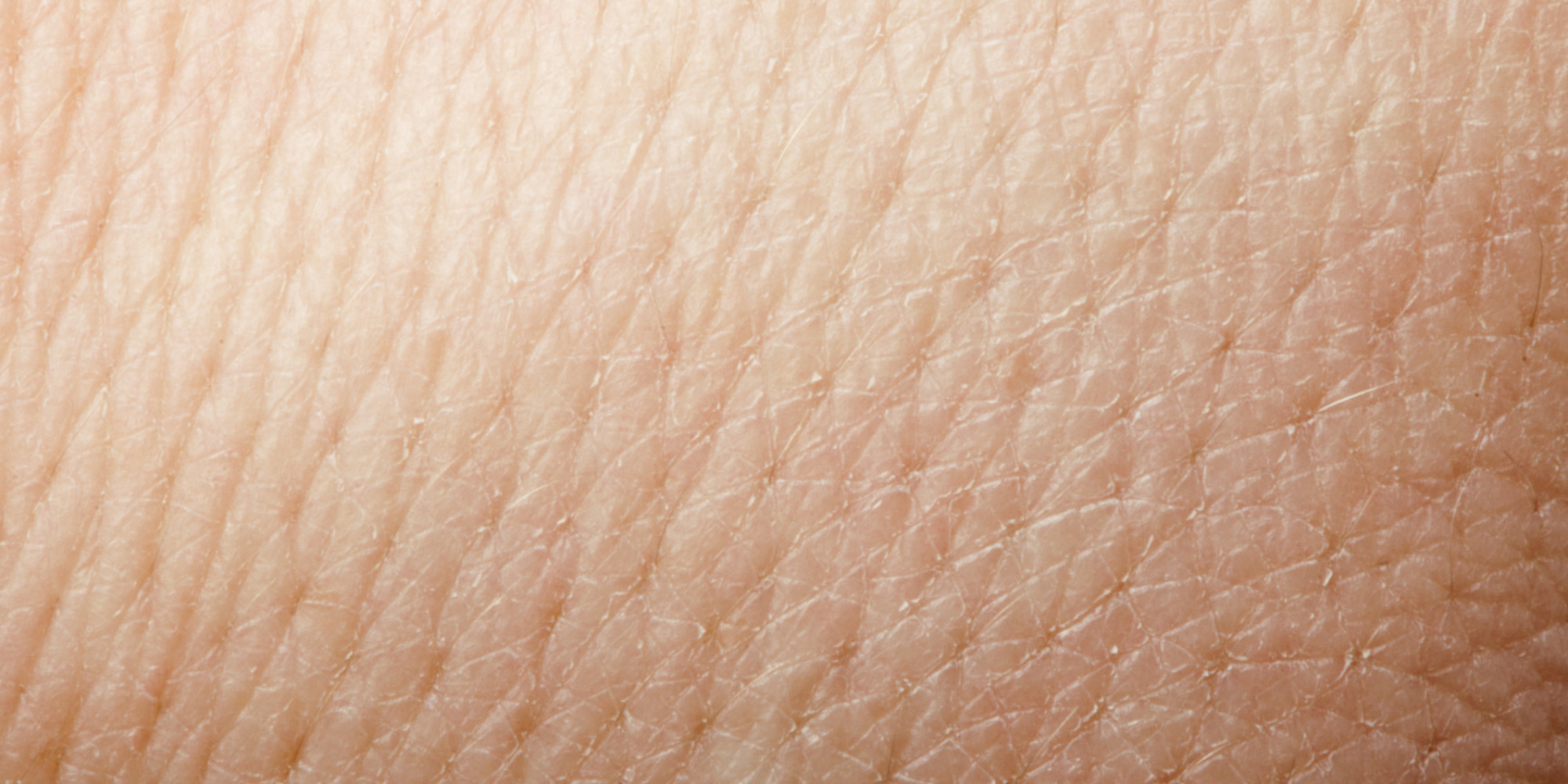 Ringworm