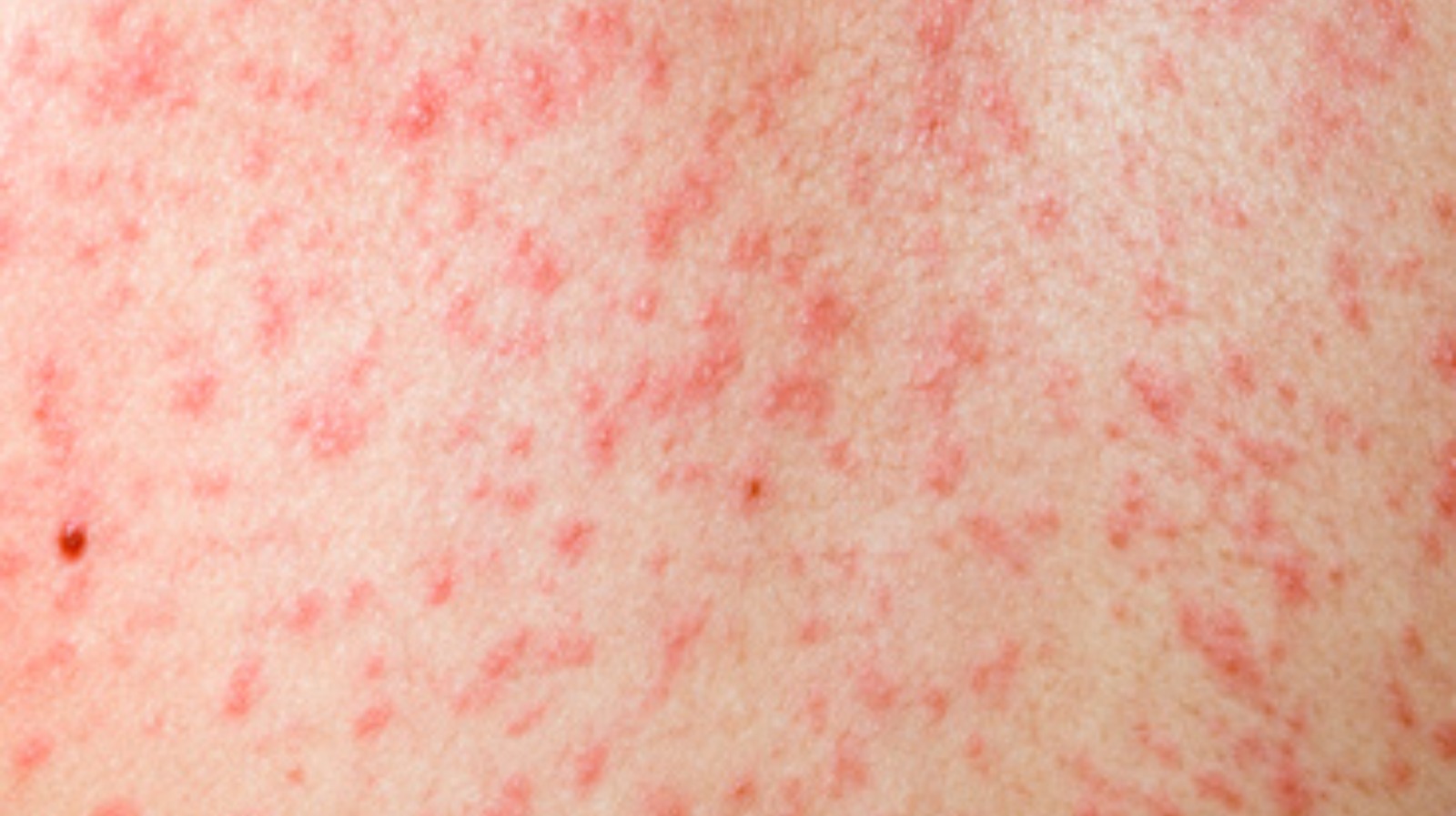 Measles rubella